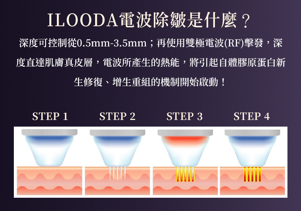 ILOODA電波除皺_悠美診所