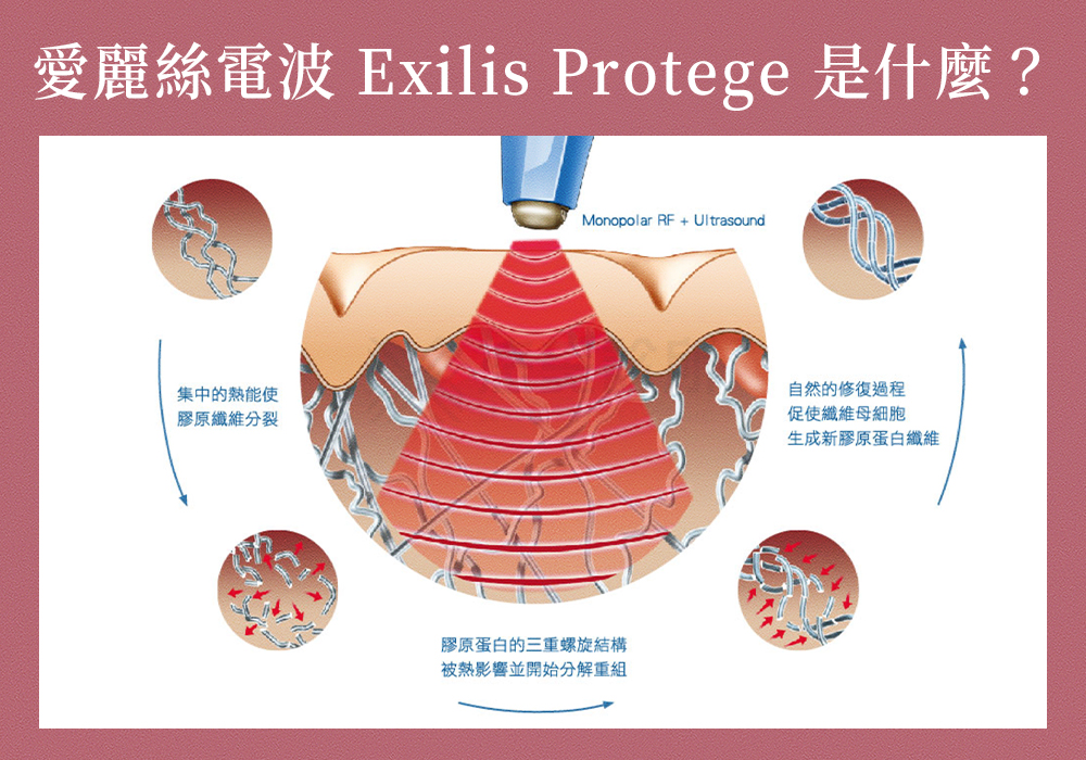 愛麗絲電波（俗稱超快感）_悠美診所