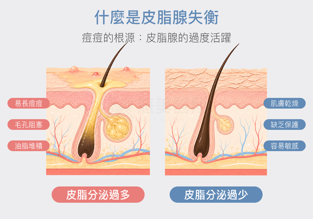 1726nm Accure油擊雷射_悠美診所