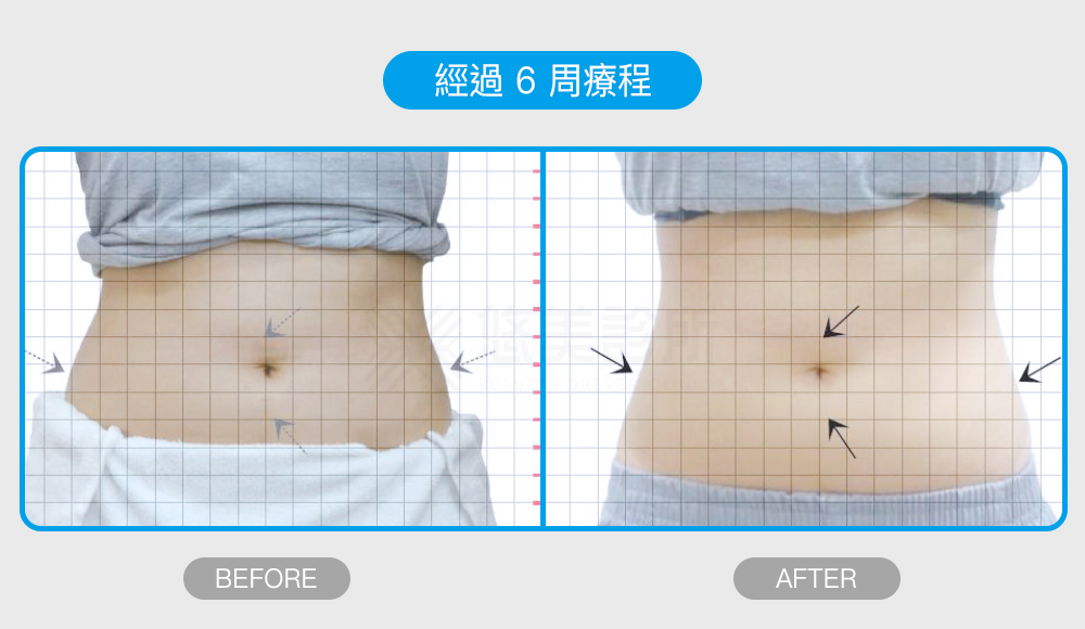 密塑冷凍減脂Micool悠美診所