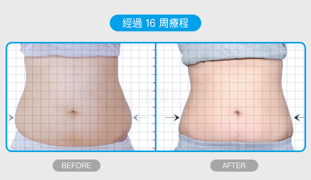 密塑冷凍減脂Micool悠美診所