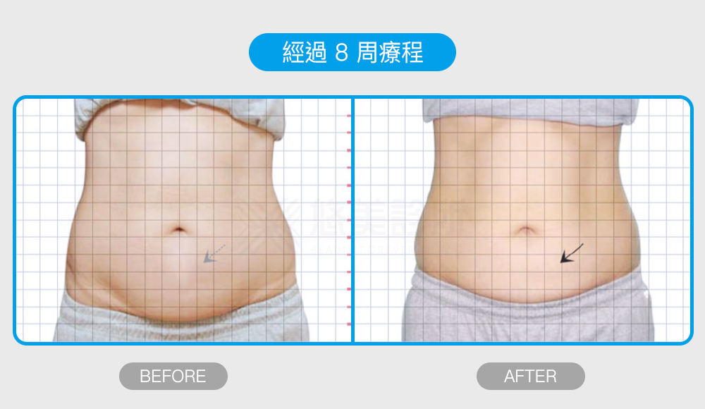 密塑冷凍減脂Micool悠美診所