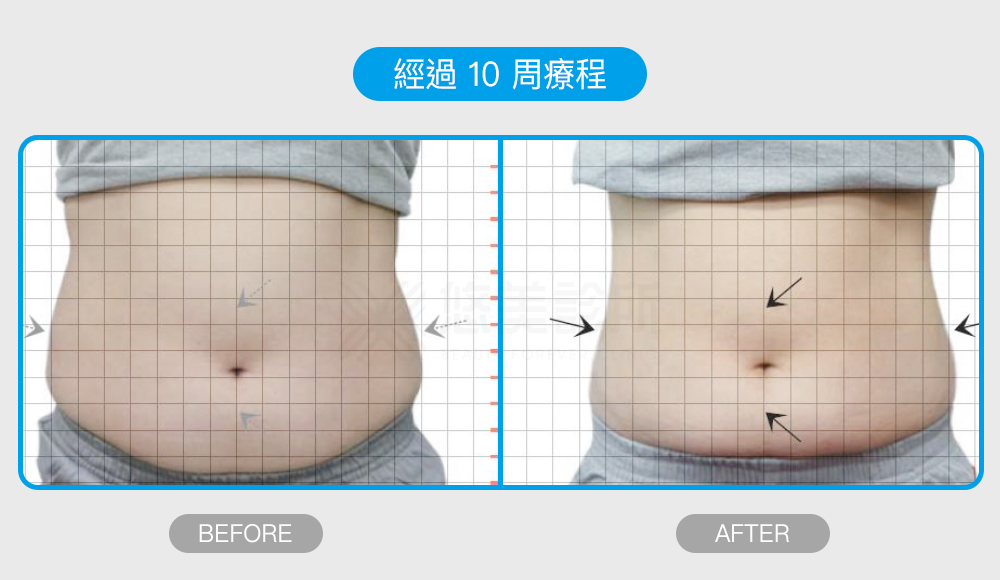 密塑冷凍減脂Micool悠美診所