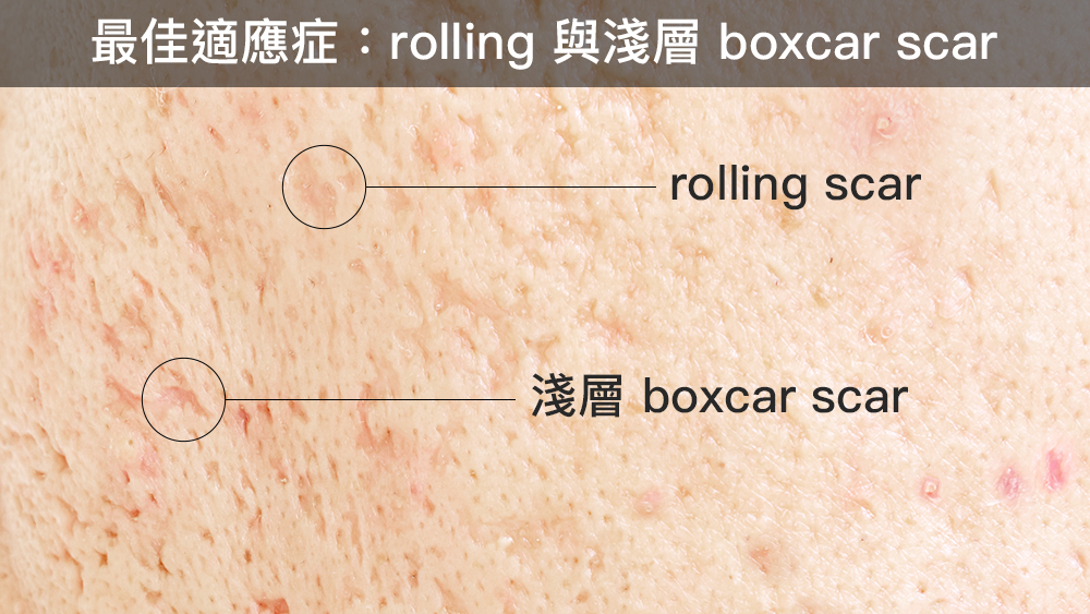 Sofwave 治療痘疤｜臨床觀察與文獻整理