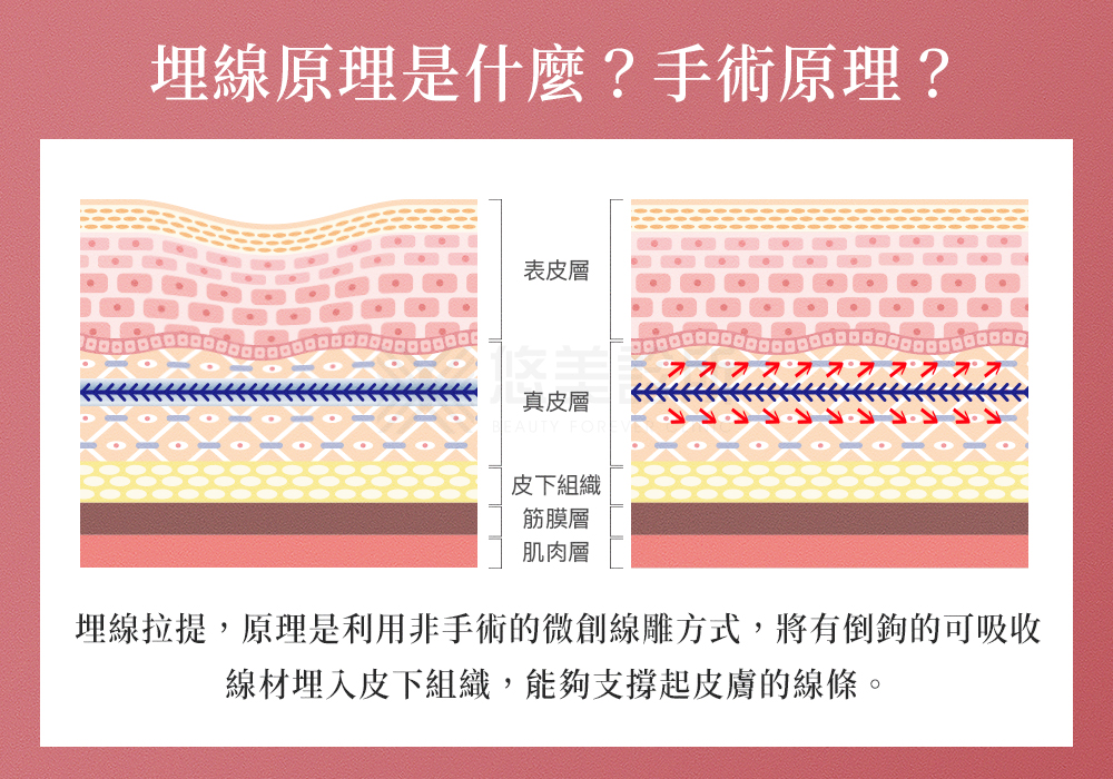 臉部埋線拉提_悠美診所