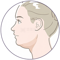 結構式天鵝頸手術_悠美診所