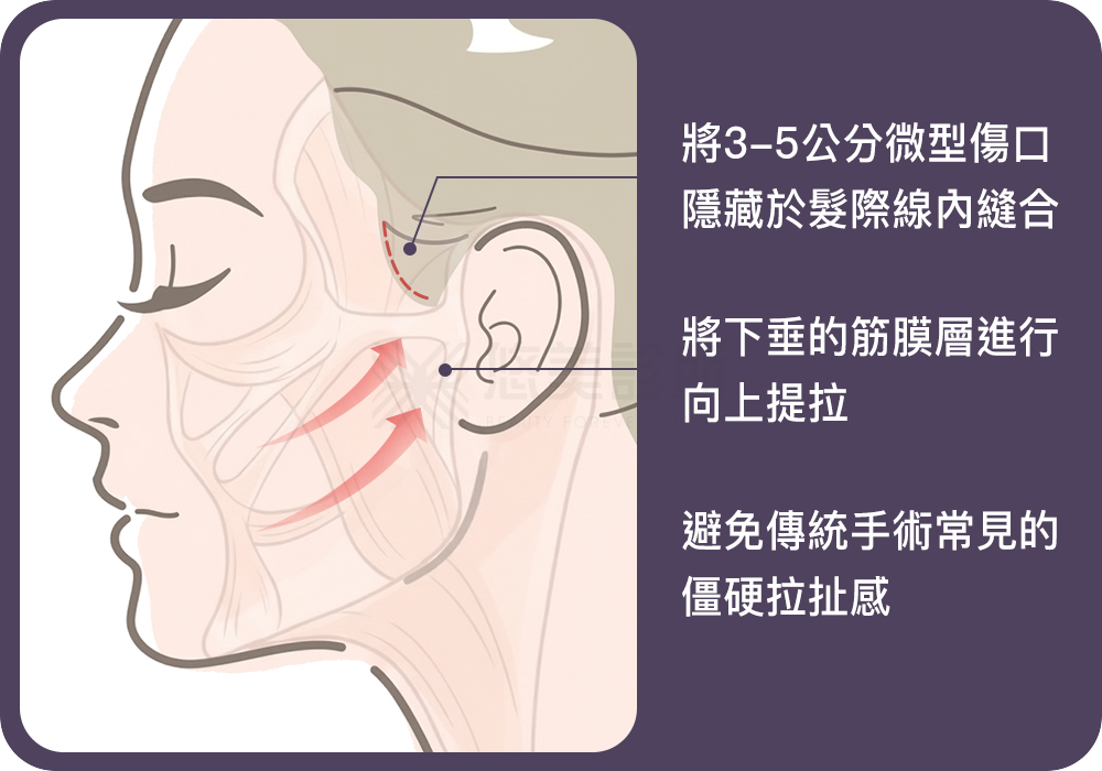 顳側拉皮手術_悠美診所