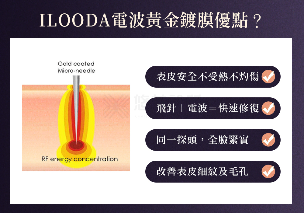 ILOODA電波除皺_悠美診所