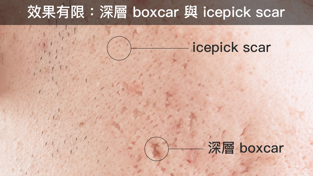 Sofwave 治療痘疤｜臨床觀察與文獻整理