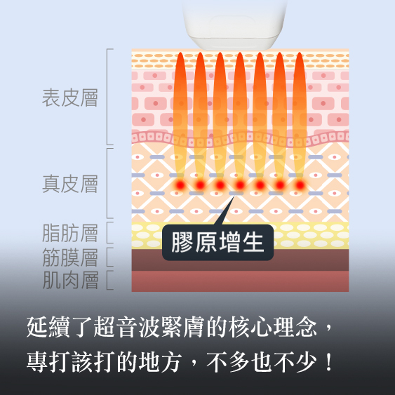 【Sofwave™】非侵入式拉提