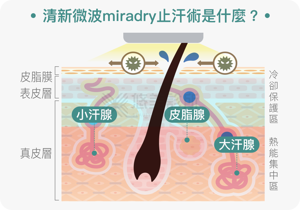 清新微波miraDry評價2024總整理!悠美診所