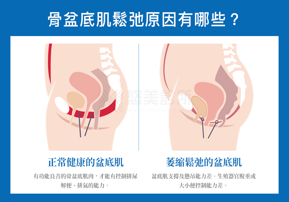 EMSELLA治療椅_悠美診所