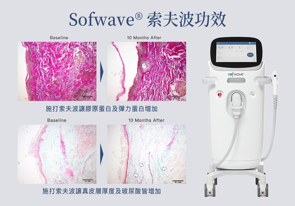 Sofwave®索夫波