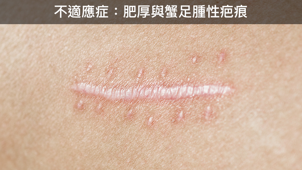 Sofwave 治療痘疤｜臨床觀察與文獻整理