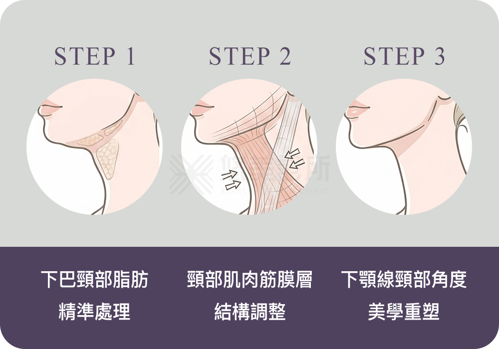 結構式天鵝頸手術_悠美診所