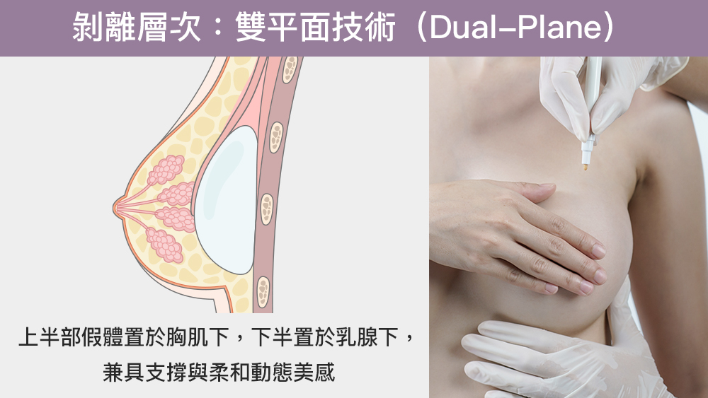 隆乳攻略｜雕塑如權恩妃般渾圓、自然動感胸型