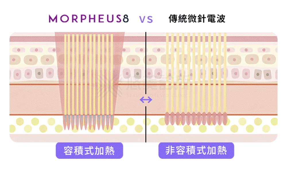 EMTONE擊脂槍_悠美診所