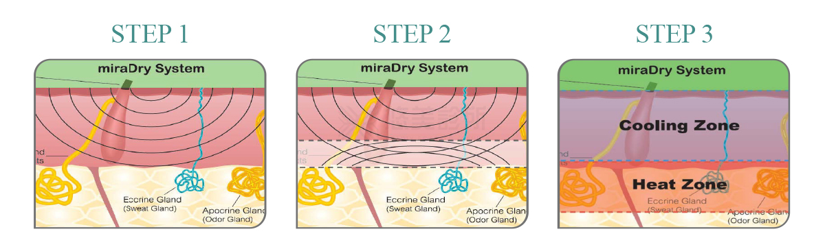 清新微波miraDry評價2024總整理!悠美診所