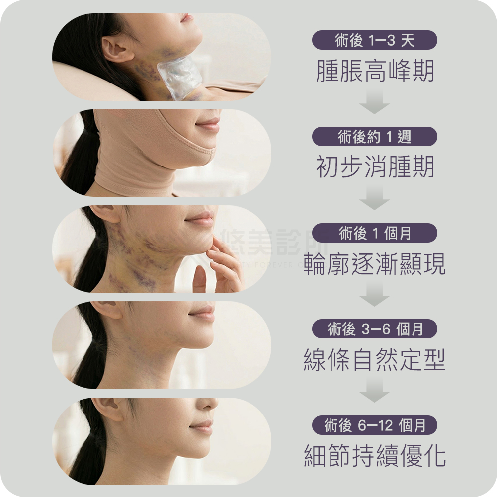 結構式天鵝頸手術_悠美診所