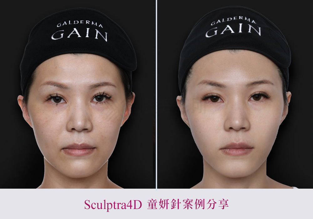 舒顏萃硬塊-悠美診所